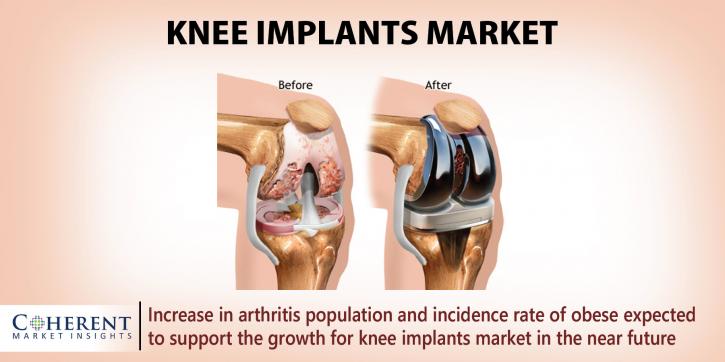 Image for Knee Implants Market - Industry Analysis, Size, Share, Growth, Trends and Forecast to 2025 with ID of: 1837289