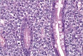 Image for Peripheral T-Cell Lymphomas (PTCL)-Global API Manufacturers, Marketed and Phase III Drugs Landscape, 2017 with ID of: 1845811