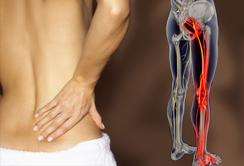 Image for sciatica Treatment in Mumbai with ID of: 1869791