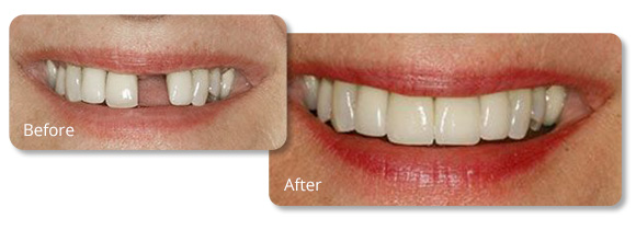 Image for Dr. Berzin Dental Implants with ID of: 1879678