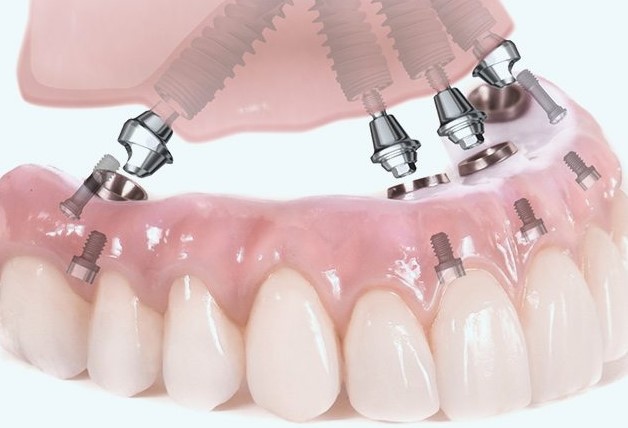 Image for Teeth in a Day Florida with ID of: 1879744