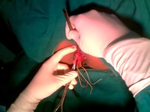 Image for Piles Surgery cost in Chennai with ID of: 1884261