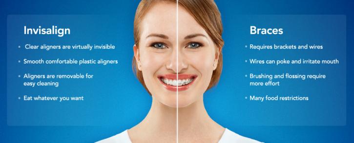 Image for Braces to Invisalign – Corrective Equipment are Plenty in Variations with ID of: 1989286