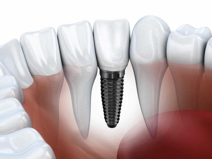 Image for Try All on 4 Dental Implants San Diego to Beautify Your Smile with ID of: 1989417
