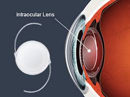 Image for Intraocular Lens Market Size , Share and Forecast till 2025 with ID of: 1999732
