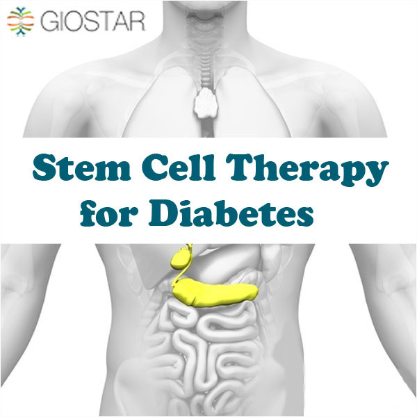 Image for Stem Cell Therapy On The Way Of Destroying Diabetes From Its Roots with ID of: 2000261