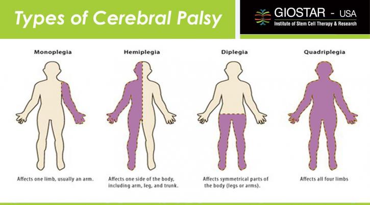 Image for Challenges And Issues In Stem Cell Therapy Research For Cerebral Palsy Treatment with ID of: 2010502