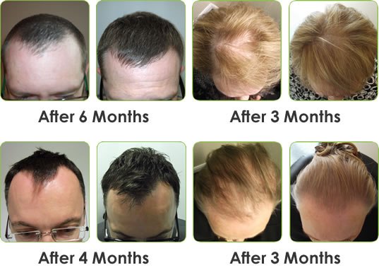 Image for Regrow Hair Protocol Reviews with ID of: 2037895