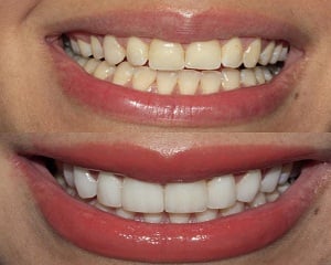 Image for Invisalign with ID of: 2038435