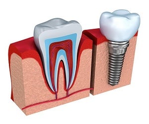 Image for Invisalign with ID of: 2038437