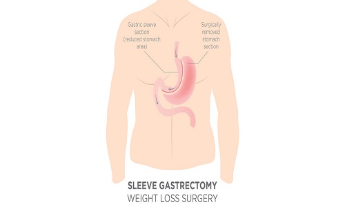 Image for Gastric Sleeve Surgery with ID of: 2085146