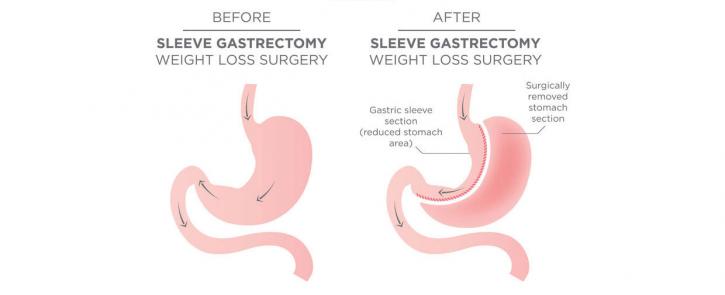 Image for Gastric Sleeve Surgery with ID of: 2203823