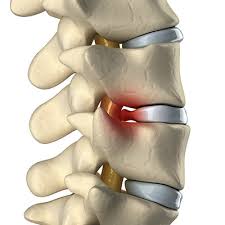 Image for Recent Advances In Technology Is Expected To Favor The Growth Of Degenerative Disc Disease Treatment Market In Near Future. with ID of: 2318458