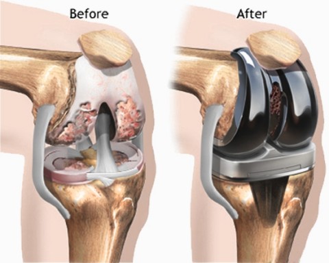 Image for Knee Implants Market – Global Opportunity Analysis, 2017–2025 with ID of: 2322202