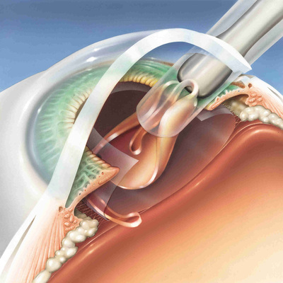 Image for USD 4,500 Million expected for Global Intraocular Lens Market at 5% CAGR by 2022 with ID of: 2335124