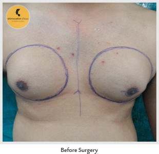 Image for Gynecomastia Surgery in Delhi with ID of: 2430502