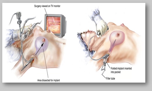 Image for Breast Reduction surgery in delhi with ID of: 2430551
