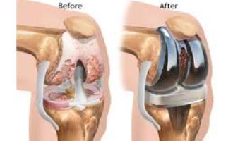 Image for total knee replacement surgeon in delhi with ID of: 2438458