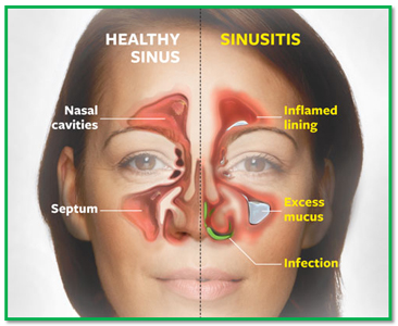 Image for Ayurvedic Treatment for Sinus with ID of: 2438618