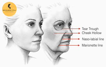 Image for Dermal Fillers in Delhi with ID of: 2440245