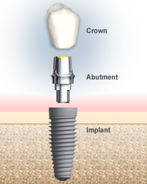 Image for Osseointegration Implants Market-Report Highlights the Competitive Scenario with Impact of Drivers and Challenges with ID of: 2450111