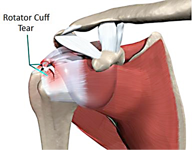 Image for Rotator Cuff Jacksonville with ID of: 2470622