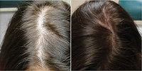 Image for Sani PRP Hair MD with ID of: 2470977