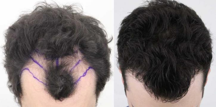Image for Rahal Hair Transplant Toronto with ID of: 2501357