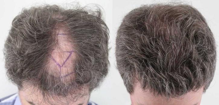 Image for Rahal Hair Transplant Toronto with ID of: 2501361