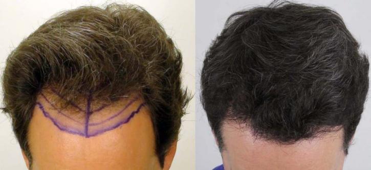 Image for Rahal Hair Transplant Toronto with ID of: 2501363