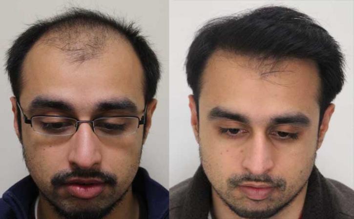 Image for Rahal Hair Transplant Toronto with ID of: 2501364