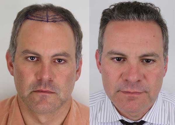 Image for Rahal Hair Transplant Toronto with ID of: 2501370