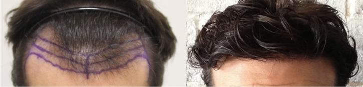 Image for Rahal Hair Transplant Toronto with ID of: 2501372