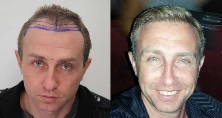 Image for Rahal Hair Transplant Toronto with ID of: 2501378