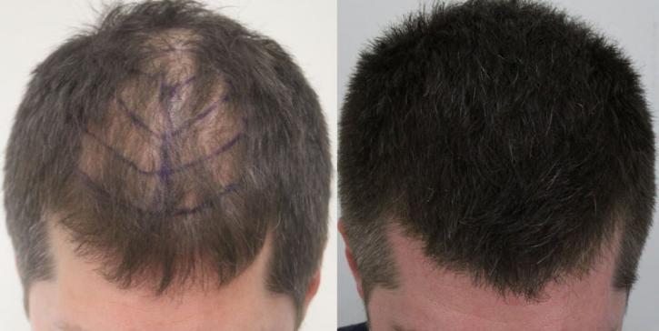 Image for Rahal Hair Transplant Toronto with ID of: 2501384