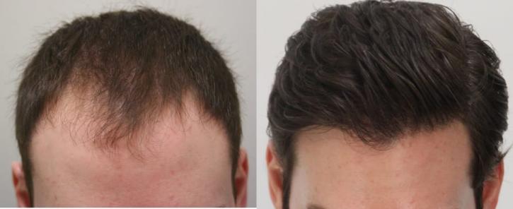 Image for Rahal Hair Transplant Toronto with ID of: 2501395