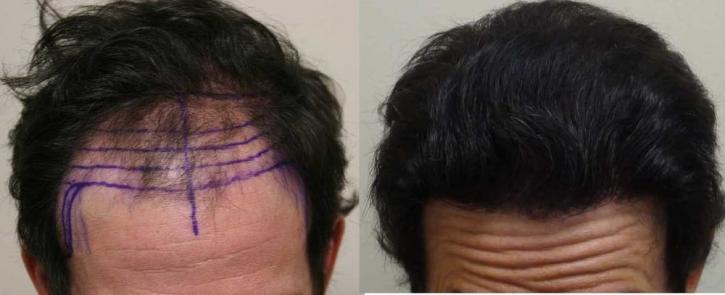 Image for Rahal Hair Transplant Toronto with ID of: 2501399
