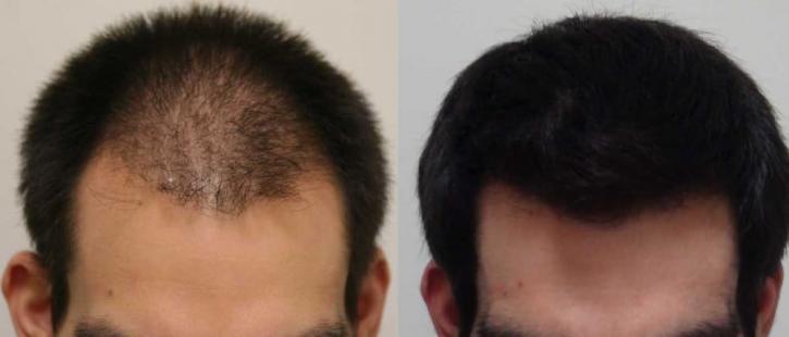 Image for Rahal Hair Transplant Toronto with ID of: 2501403
