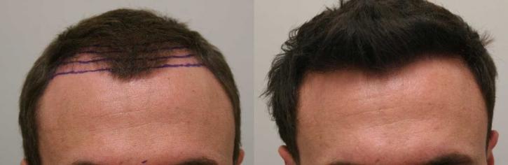Image for Rahal Hair Transplant Toronto with ID of: 2501404