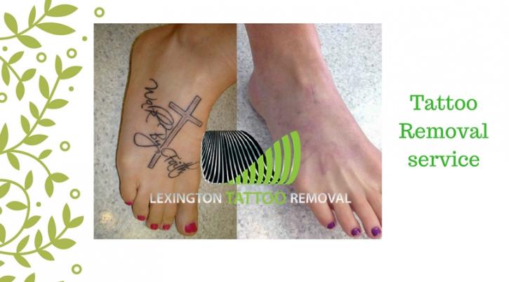 Image for Lexignton Tattoo Removal with ID of: 2523664