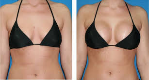 Image for Their Breasts Changed Shape following Pregnancy with ID of: 2543760