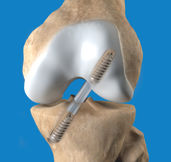 Image for Bioabsorbable Bone Screw Market - Size, Share, Outlook, and Forecast till 2026 with ID of: 2630751