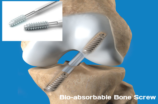Image for Bio-absorbable Bone Screw Market - Size, Share, Outlook, and Analysis, 2018 - 2026 with ID of: 2651748