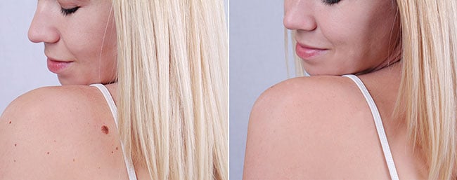 Image for Skin Mole Removal Edmonton with ID of: 2717995