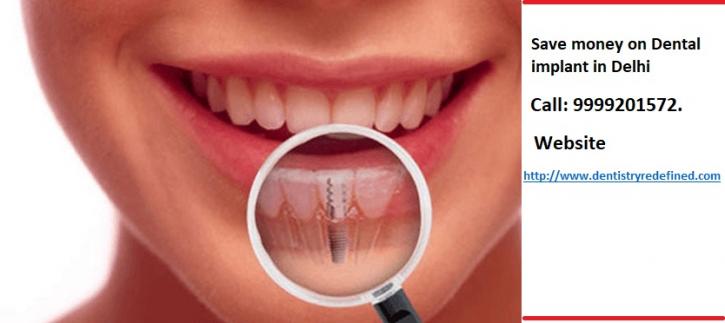 Image for Save money on Dental Implants in Delhi with ID of: 2743356