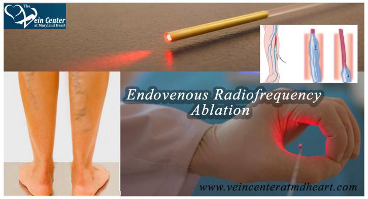 Image for Varicose Veins Treatment with ID of: 2744817