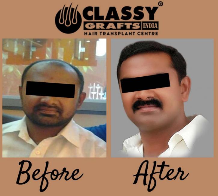 Image for Classy Grafts - Hair Transplant Centre with ID of: 2745651