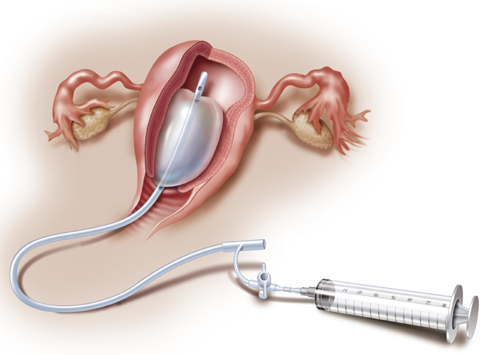 Image for Growing Demand for Postpartum Hemorrhage (PPH) Devices Market in the Medical Industry with ID of: 2775987