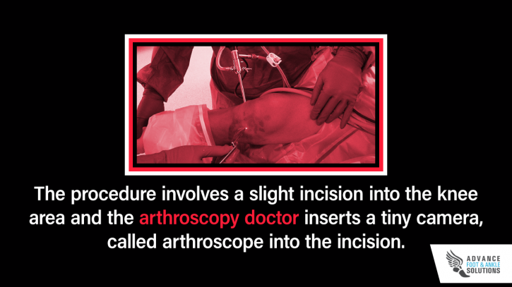 Image for What is Knee Arthroscopy? with ID of: 2779676