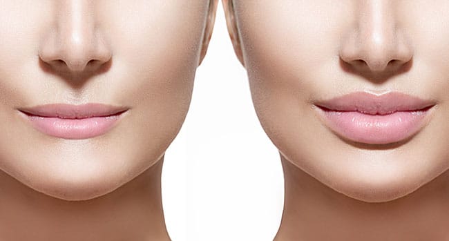 Image for Lip Filler with ID of: 2781944